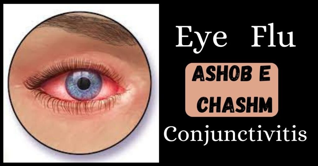 eye flu, ashob e chashm, Conjunctivitis
